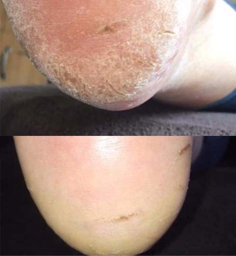 Callus treatment services in Danbury, Essex